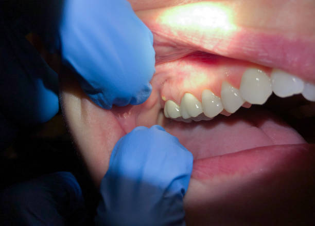 Best Emergency Denture Repair in Ankeny, IA